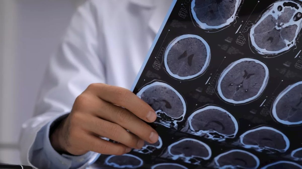 Bărbat diagnosticat greșit cu cancer cerebral avea de fapt tenii vii