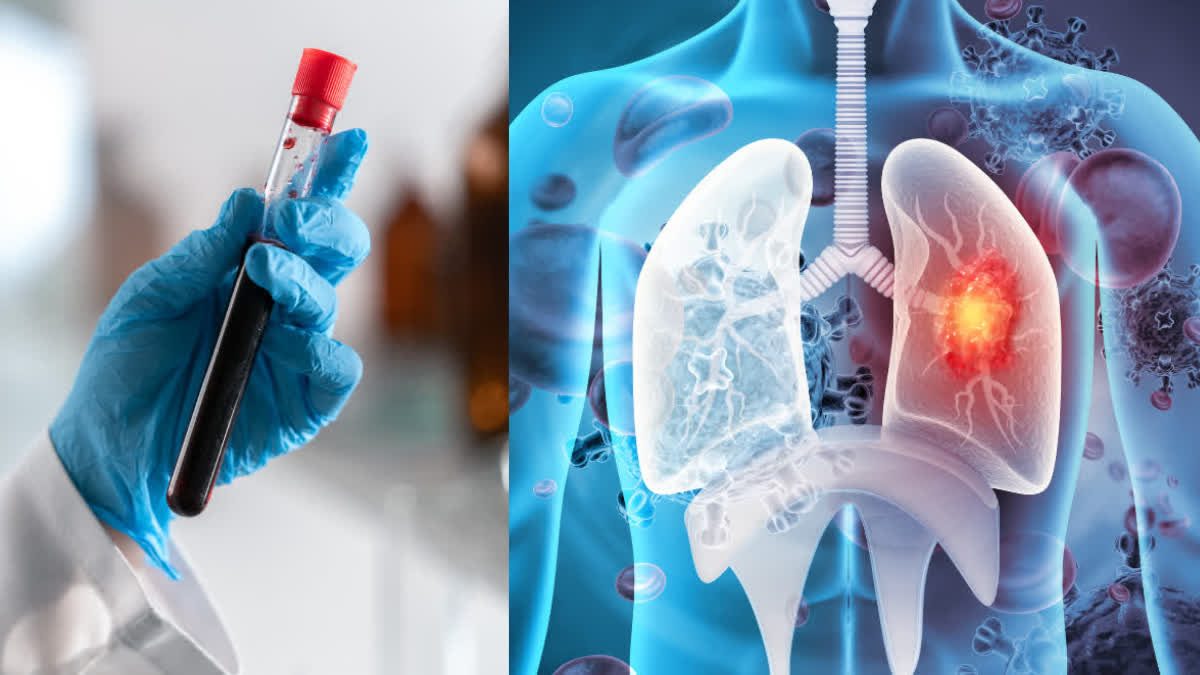 Nový krvný test odhalí rakovinu pľúc až päť rokov pred objavením sa príznakov