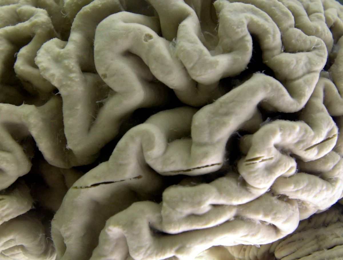 Krevní test identifikuje riziko Alzheimerovy choroby u zdravých jedinců