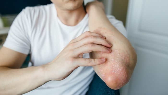 Tør hud eller ømme ben? Mulige tegn på vitaminmangel